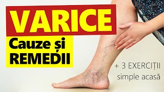 Cum SCAPI de VARICE Cauze Remedii  3 exerciţii SIMPLE acasă [upl. by Ameg466]