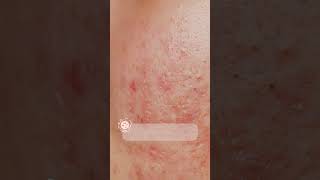 Is it Acne or Rosacea  Ensoul Medical Clinic [upl. by Akire]