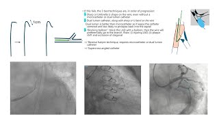 Wiring techniques through difficult angulations [upl. by Catha]