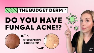 5 Signs You Have Fungal Acne…NOT Regular Acne  The Budget Derm Explains [upl. by Publius814]