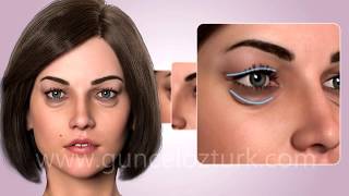 Cosmetic Eye Surgery  Upper and Lower Eyelid Aesthetic  Blepharoplasty Guncel Ozturk MD  DRGO [upl. by Nyrroc]