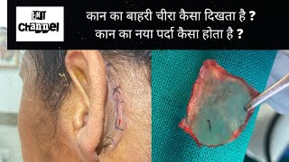 Outer incision for ear operation  How does new eardrum membrane looks like [upl. by Markiv]