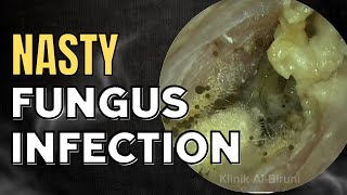 NASTY Fungus Infection Thoroughly Cleaned [upl. by Itraa503]