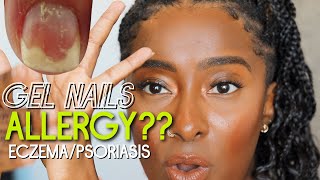 Allergic To Gel Nails EczemaPsoriasis of the Nails [upl. by Jilly]