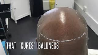 This is Scalp MicroPigmentation to Cure Baldness [upl. by Halli107]