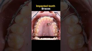 Braces for impacted tooth braces orthodontist dentist dentisty [upl. by Pega]