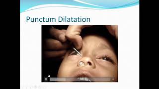 Tackling Nasolacrimal Duct Obstructions  Dr Milind Killedar [upl. by Theola740]