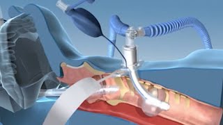 Portex® ULTRAperc® Percutaneous Dilation Tracheostomy Kit [upl. by Liba]