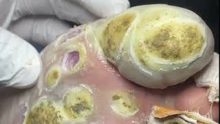 Pedicure video28，vertical plantaris，plantar wart [upl. by Steven]