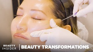 How Nonsurgical FaceLifts Work With PDO Threads  Beauty Transformations  Insider Beauty [upl. by Inanaup]