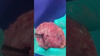 Radical Prostatectomy for Prostate Cancer with HYBRID ROBOTICS  Dr Krishnamohan  Dr Krish Talks [upl. by Antone]