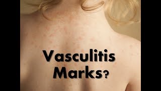 How To Cure Vasculitis Home remedies For Vasculitis [upl. by Chapel]