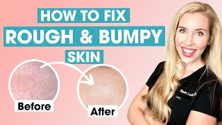 How To Fix Rough and Bumpy Skin  Keratosis Pilaris Affordable Skincare Routine [upl. by Terza]