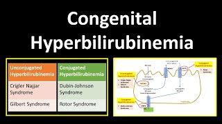 Congenital Hyperbilirubinemia  Crigler Najjar SyndromeGilbert SyndromeDubinJohnson Syndrome [upl. by Weitman]