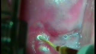 Nabothian cyst [upl. by Edaw]