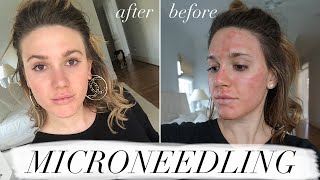 MY FIRST MICRONEEDLING EXPERIENCE amp WHAT TO EXPECT ACNE SCAR TREATMENT [upl. by Pentheas]