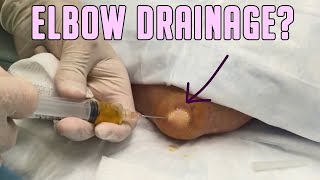 Aspiration Double Feature  Elbow and Wrist Drainage [upl. by Itraa]