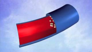 Foam Sclerotherapy  What is Sclerotherapy [upl. by Novanod]