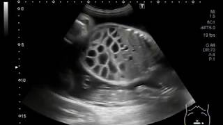 Ultrasound Video showing dilated gut loops of the fetus and anomalies [upl. by Atilegna]