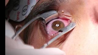 Corneal Iontophoresis Procedure [upl. by Riba627]