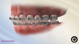 David Ross Orthodontics Elastics  How to wear Crossbite Rubber bands [upl. by Ilarin250]