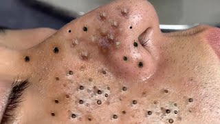 Blackheads amp Acne Treatment Latest Update 64 [upl. by Yelsek]