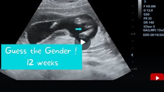 12 weeks ultrasound  Guess the gender [upl. by Aicemed591]