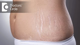 Are topical creams amp oils effective for reducing stretch marks  Dr Urmila Nischal [upl. by Iverson]