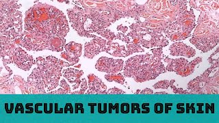 Vascular Tumors of Skin 31 cases in 3 hours Board Review for Pathology Dermatology Dermpath [upl. by Einial]