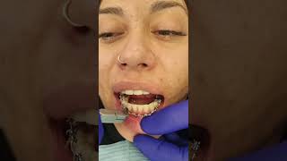 La Increíble Experiencia de Nuestra Paciente Brackets Quitados en Directo saludbucal [upl. by Melcher218]