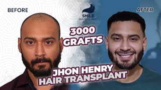 Captivating Transformation 3000 Grafts Hair Transplant Before and After Stunning 12Month Results [upl. by Ikkir]