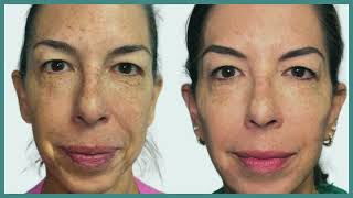 Sculptra Liquid Facelift [upl. by Riha]