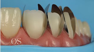 Direct veneering using composite resin with new unica proximal matrix the simplified approach [upl. by Finah]