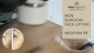 Non Surgical Face Lift NeoFirm Radiofrequency Facial by Neo Elegance [upl. by Coad453]