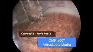 Artroskopia biodra  artroskop przygotowanie procedura i powikłania  OMP 007 [upl. by Groh]