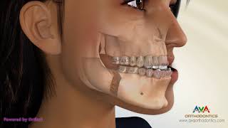 Surgical Orthodontic Treatment for Underbite or Crossbite  Transcortical Mandibular Setback [upl. by Arimihc]