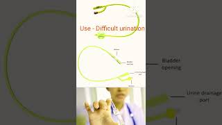 Foley catheter Uro bag Use of Foley catheter amp uro bag  medical  medical amp hospital knowledge [upl. by Bacon]