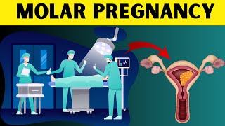 Molar Pregnancy Explained Types Symptoms Diagnosis and Treatment Hydatidiform Mole Overview [upl. by Harvie]