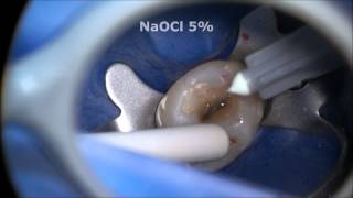 Endodontic Access and Root Canal Preparation explained [upl. by Birdie]