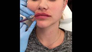 Juvederm Volbella Lip Filler Enhancment with Before and After Photos [upl. by Tedra603]