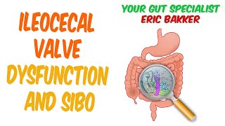 Ileocecal Valve Dysfunction And SIBO [upl. by Gwyneth]