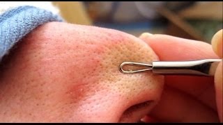 3A of 4 Removing Blackheads amp Whiteheads Using A Comedone Extractor Tool HD [upl. by Kristofer]