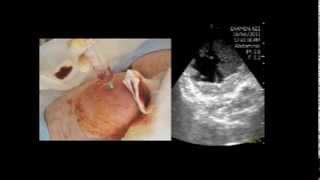 VSCAN Abscess in the femoral region Pocket Ultrasoundguided puncture absceso crural [upl. by Lowell]