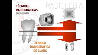 Radiologia em Endodontia  Técnica de Clark [upl. by Uoliram]