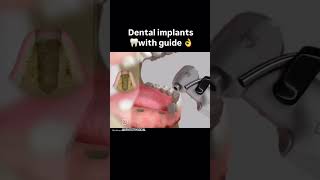 Dental Implant dental dentist dentistdoctor dentistry medicaldoctor smiledental shortvideo [upl. by Robbie]