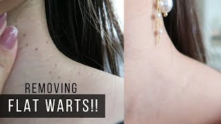 FINALLY REMOVING FLAT WARTS OMG [upl. by Ayotnahs]