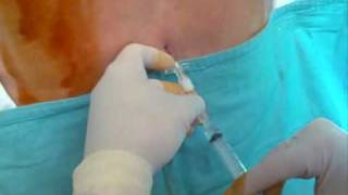 CSE combined spinal epidural anaesthesia needle to needle tecnique [upl. by Idnal]