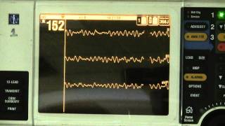 Ventricular Fibrillation [upl. by Tibbitts319]