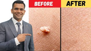 Remove Skin Tags and Warts Within 24 Hours  DrVivek Joshi [upl. by Billat]