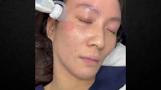 Juvelook Collagen Skinbooster with Dermashine Injector Gun [upl. by Noslien]